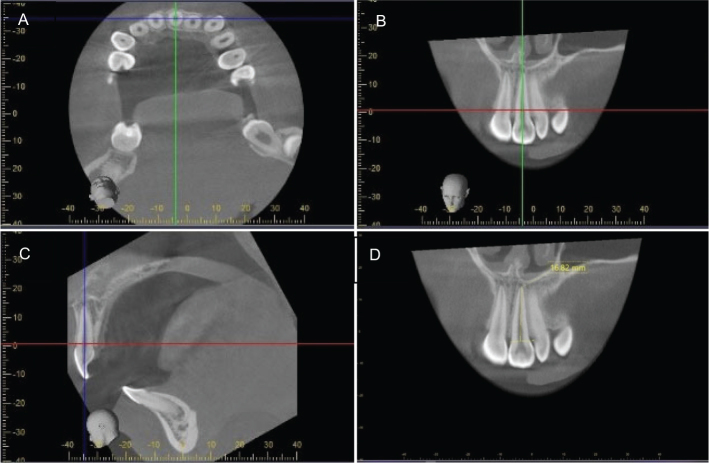 Reliability and agreement of root length measurements during orthodontic treatment in images from different CBCT machines using multiplanar reconstruction.