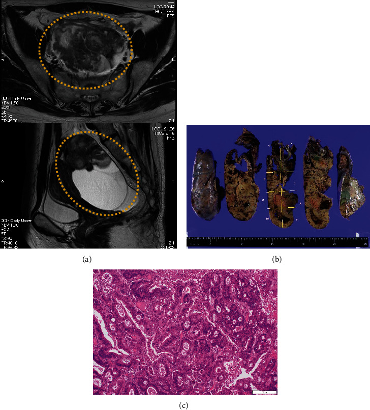 A Rare Case of Small Intestinal Cancer With Uterine Metastasis After Surgery for Ovarian Metastasis, Diagnosed Using Immunostaining.