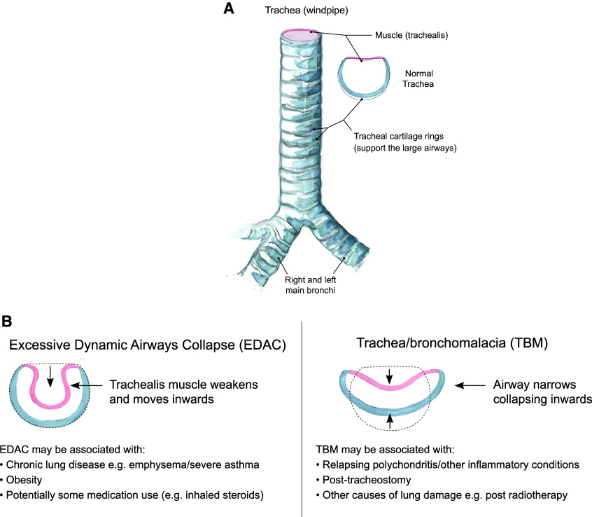 Tracheobronchomalacia and Large Airway Collapse.