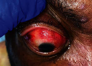 Progression of Sclerouveitis to Endogenous <i>Fusarium</i> Endophthalmitis.