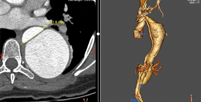 Mechanical Injury of Thoracic Aorta by Elephant Trunk Graft Limb following Frozen Elephant Trunk Procedure.