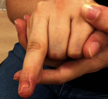 Therapeutic Response of Alopecia Areata-Associated Nail Changes to Baricitinib.