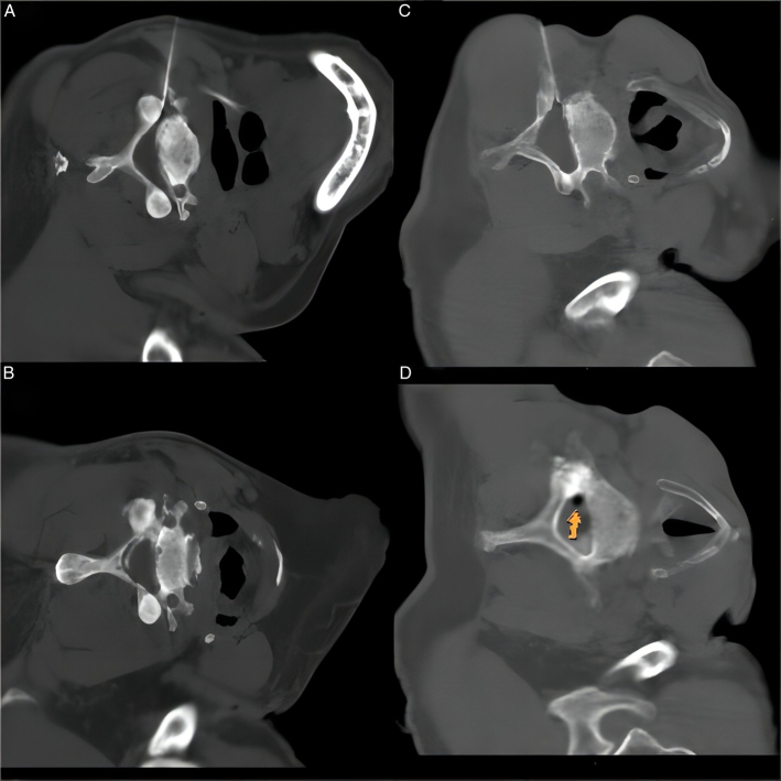 Computed Tomography-Guided Dorsal Root Ganglion Ozone Injection Combined With Pulsed Radiofrequency for Acute Herpes Zoster Neuralgia Treatment of Middle-aged and Elderly People: A Randomized, Double-blinded, Controlled Trial.