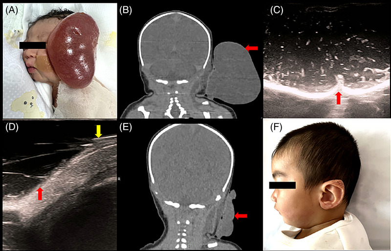 A neonate in emergency for giant auricular and cervical lymphatic malformations: Ultrasound-guided percutaneous bleomycin sclerotherapy may be a choice.