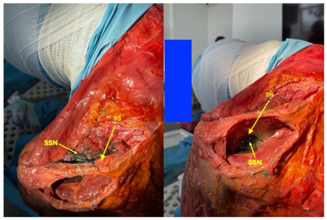 Identification of the Suprascapular Nerve with Minimal Volume of Contrast Medium: A Cadaveric Case Study.