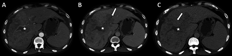 Multiphasic Computed Tomography Enhancement Characteristics and Utility of Delayed Phase in Infiltrative Hepatocellular Carcinoma.