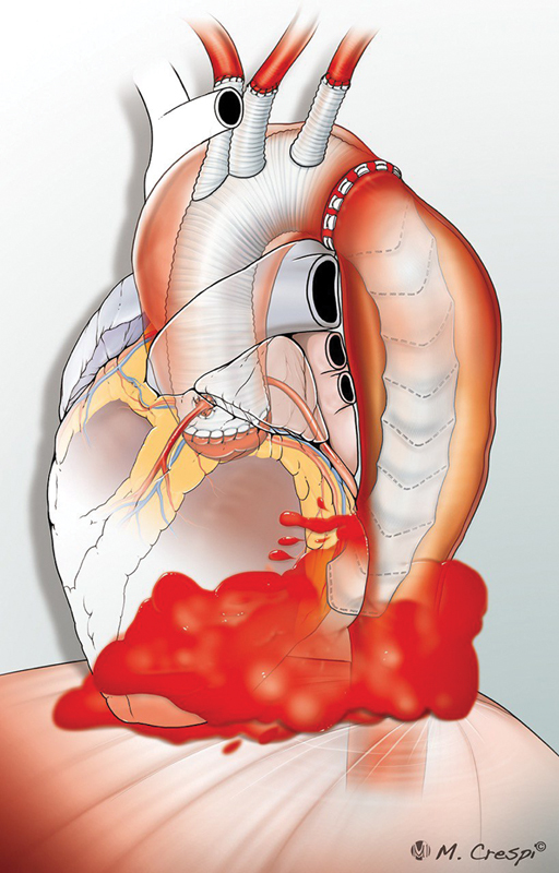 Mechanical Injury of Thoracic Aorta by Elephant Trunk Graft Limb following Frozen Elephant Trunk Procedure.