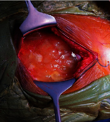 Pseudomyxoma Peritonei in a Case of Carcinoma Cervix: Subtle Finding With Implications on Management and Prognosis.