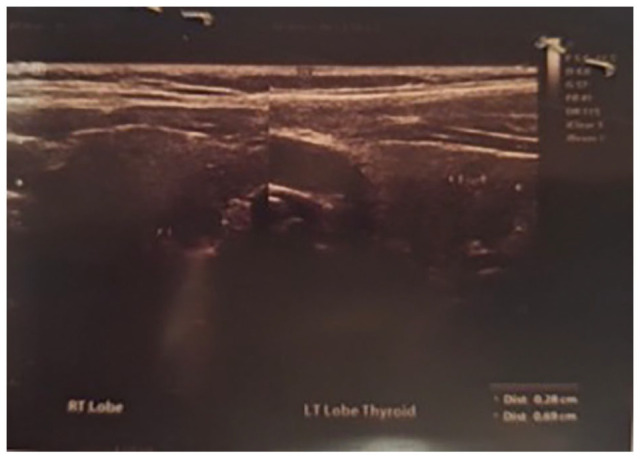 Post-COVID-19 Syndrome Associated With Multiple Autoimmune Diseases (DM I-LADA, Chronic Autoimmune Thyroiditis and Pernicious Anemia): Case Report.