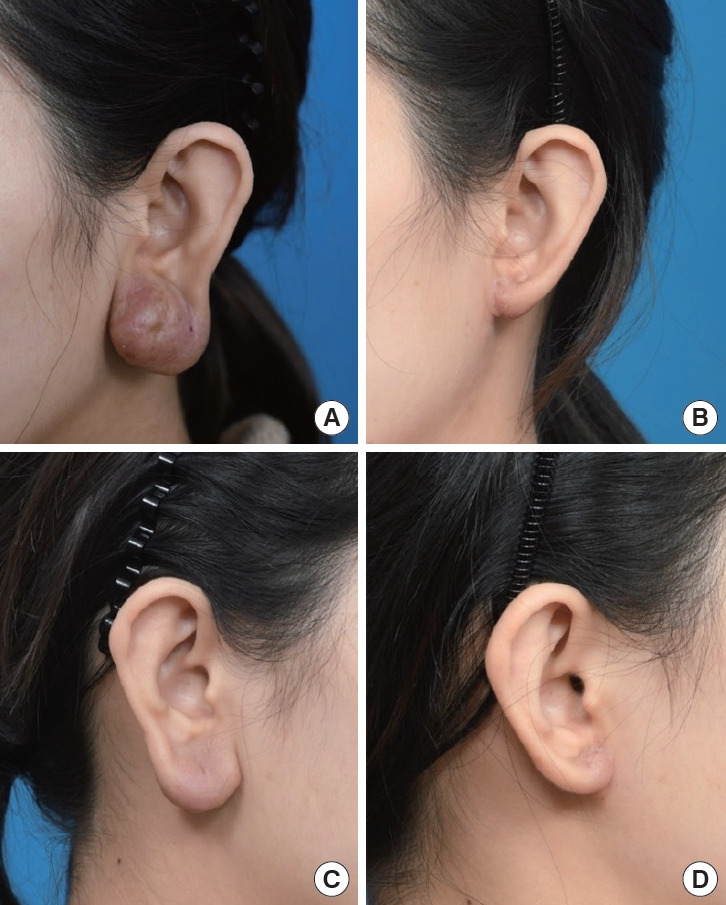 Ear lobule reduction using a sub-antitragal groove technique in patients with angiolymphoid hyperplasia with eosinophilia on the earlobe: a case report and literature review.