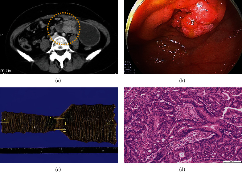 A Rare Case of Small Intestinal Cancer With Uterine Metastasis After Surgery for Ovarian Metastasis, Diagnosed Using Immunostaining.