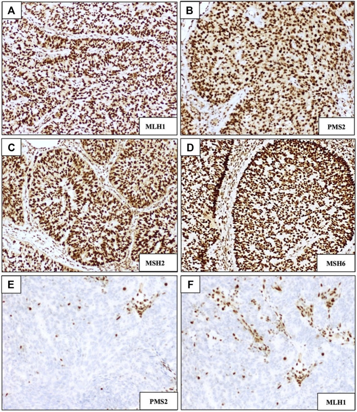 Molecular classification of endometrial cancer: preliminary experience from a single Portuguese academic center.