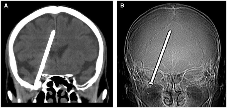 A case of MRI-induced headache caused by an intracranial foreign body.