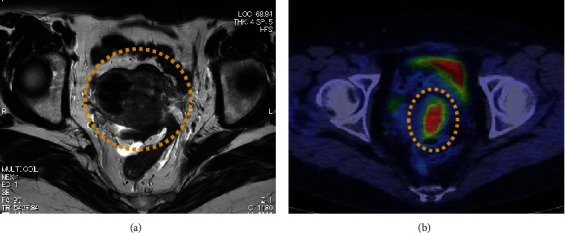 A Rare Case of Small Intestinal Cancer With Uterine Metastasis After Surgery for Ovarian Metastasis, Diagnosed Using Immunostaining.