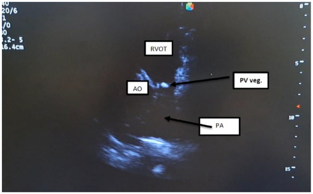 Isolated Pulmonic Valve Endocarditis: A Rare Clinical Entity.