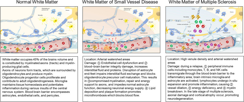 White matter disease derived from vascular and demyelinating origins.