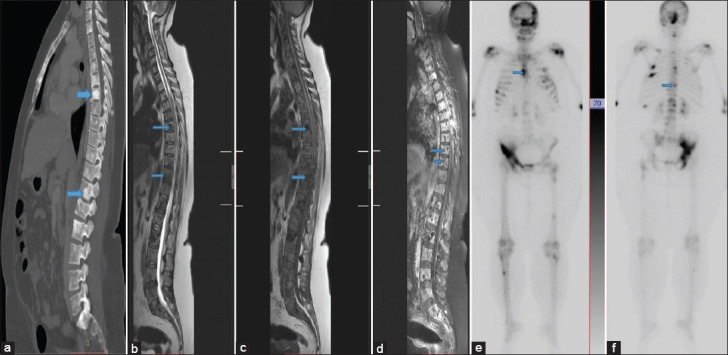 Survival Outcomes in Malignancy-related Hypercalcemia: A Tertiary Care Single-center Experience.