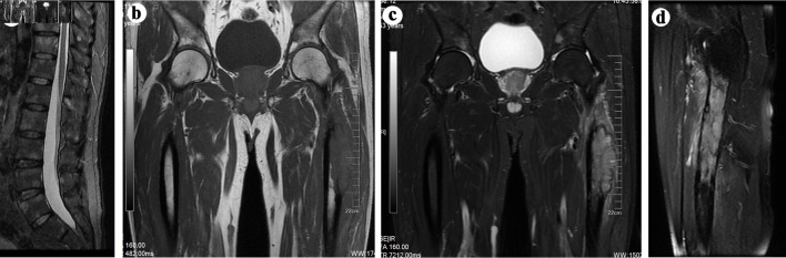 Proximal Femoral Metastasis From Epidermal Growth Factor Receptor-Mutated Lung Adenocarcinoma Mimicking Osteosarcoma on Magnetic Resonance Imaging.