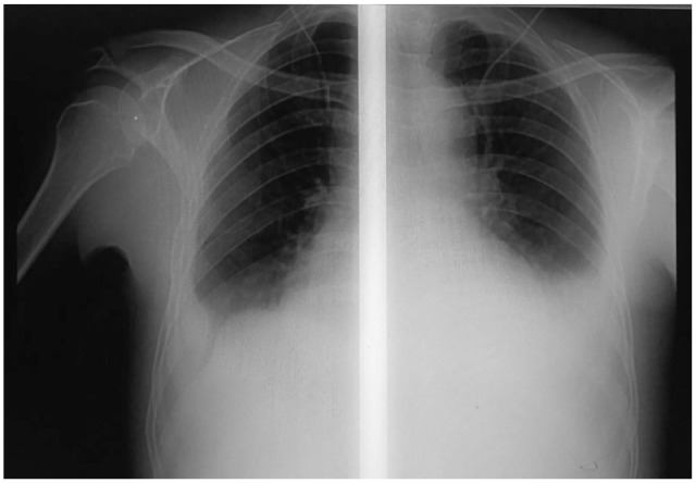 Isolated Pulmonic Valve Endocarditis: A Rare Clinical Entity.