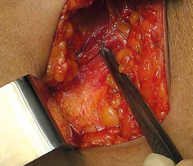 Indian Brachytherapy Society consensus recommendations for brachytherapy in breast cancer.