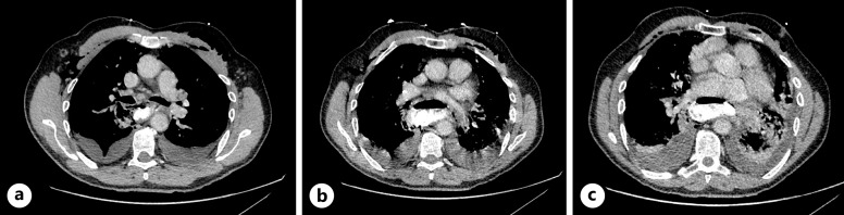 Endoluminal Vacuum Therapy for the Management of Boerhaave Syndrome: A Case Series.