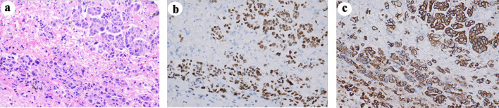 Proximal Femoral Metastasis From Epidermal Growth Factor Receptor-Mutated Lung Adenocarcinoma Mimicking Osteosarcoma on Magnetic Resonance Imaging.