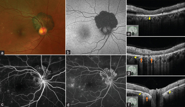 Juxtapapillary congenital hypertrophy of the retinal pigment epithelium: A report of two cases.
