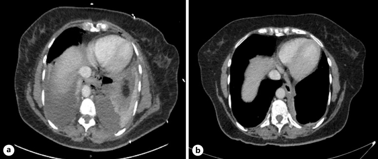 Endoluminal Vacuum Therapy for the Management of Boerhaave Syndrome: A Case Series.