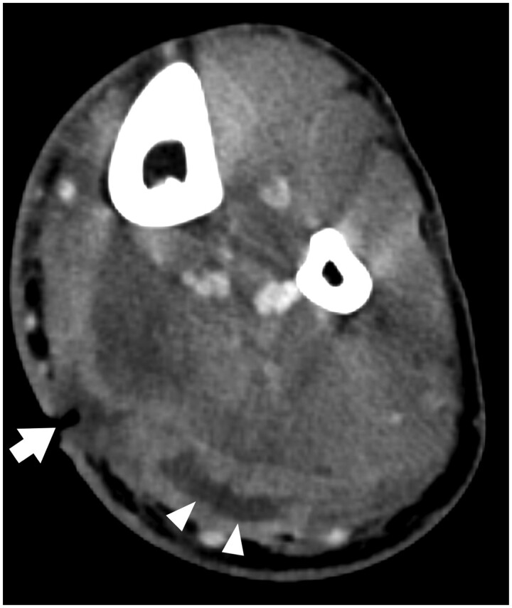 Emergency department referrals for CT imaging of extremity soft tissue infection: before and during the COVID-19 pandemic.