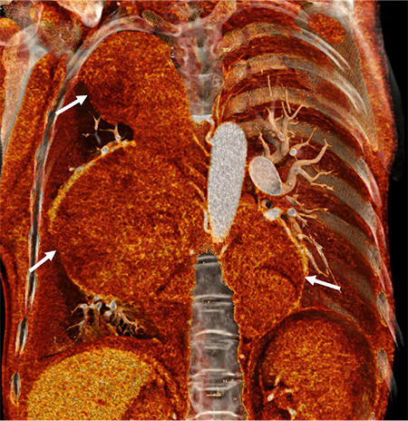 A Rare Cause of Giant Intrathoracic Mass in a Woman with Sickle Cell Disease: Extramedullary Hematopoiesis