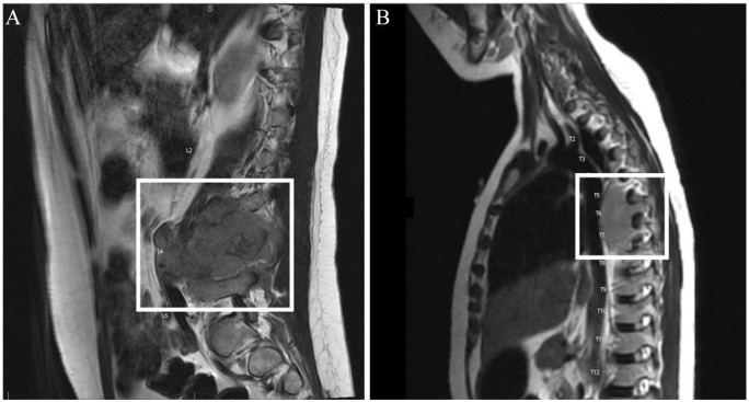 Dysuria and Vaginal Pain, Unusual Manifestations of B-acute Lymphoblastic Lymphoma.
