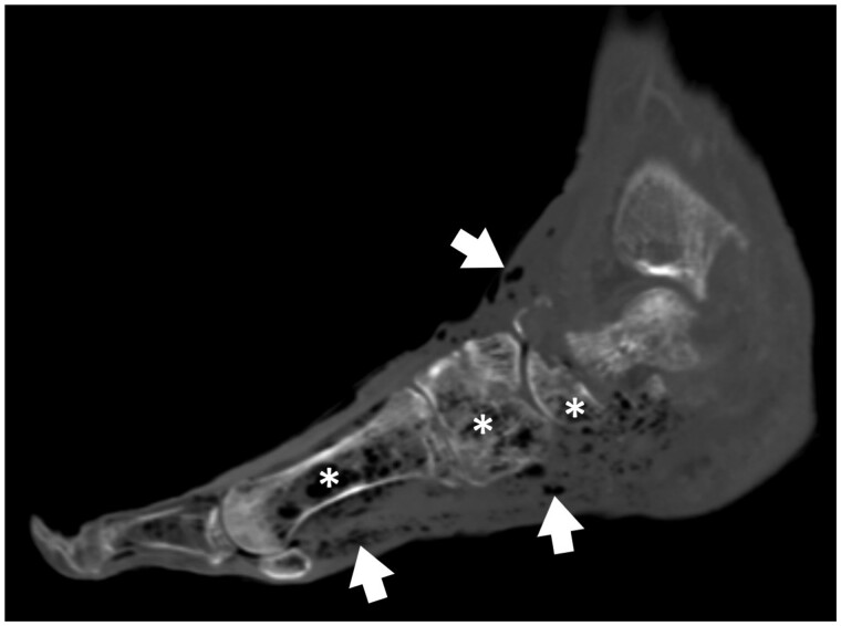 Emergency department referrals for CT imaging of extremity soft tissue infection: before and during the COVID-19 pandemic.