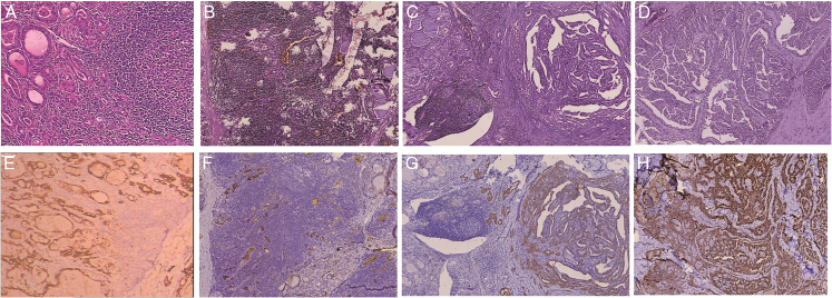 The BRAF V600E Mutation and Clinicopathological Changes Among Patients With Hashimoto Thyroiditis, Papillary Thyroid Carcinoma With Hashimoto Thyroiditis, and Nodular Goiter.