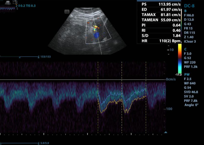 Peripartum Cardiomyopathy: A Case Report of Mortality From a Rare and Potentially Fatal Condition.