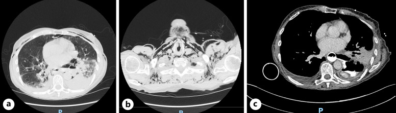 Endoluminal Vacuum Therapy for the Management of Boerhaave Syndrome: A Case Series.