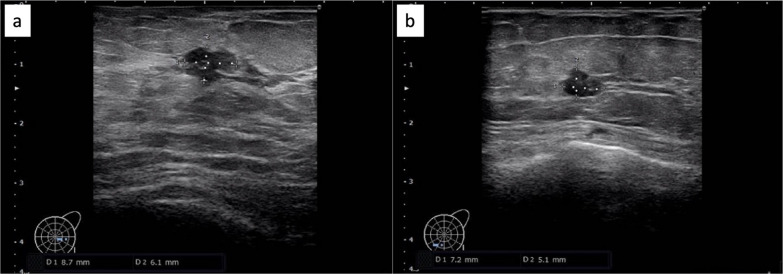 Surgical and irradiated case of early breast cancer in a patient with Ehlers-Danlos syndrome.