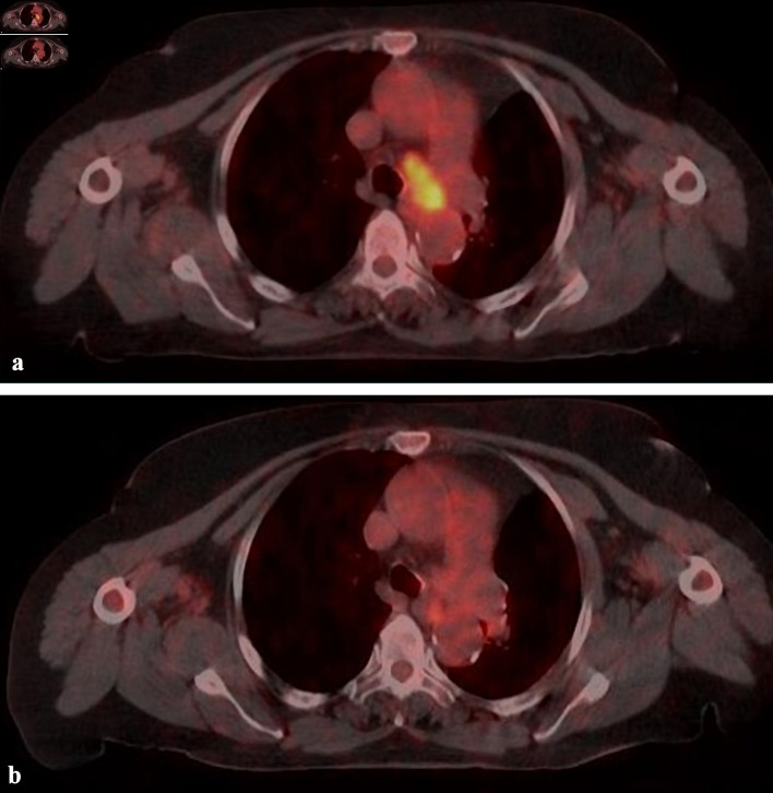 Results of Stereotactic Body Radiotherapy With CyberKnife-M6 for Primary and Metastatic Lung Cancer.