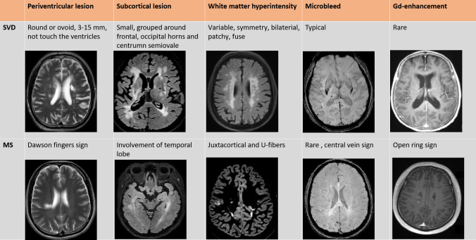 White matter disease derived from vascular and demyelinating origins.