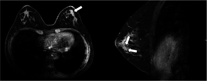 Surgical and irradiated case of early breast cancer in a patient with Ehlers-Danlos syndrome.
