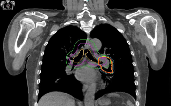 Results of Stereotactic Body Radiotherapy With CyberKnife-M6 for Primary and Metastatic Lung Cancer.