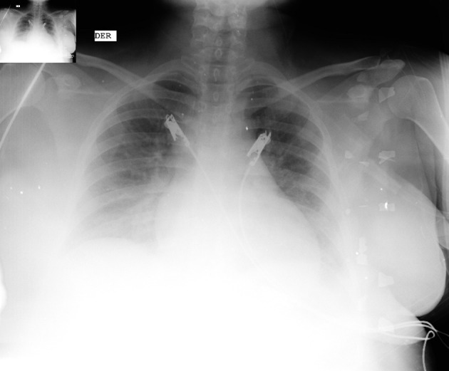Peripartum Cardiomyopathy: A Case Report of Mortality From a Rare and Potentially Fatal Condition.