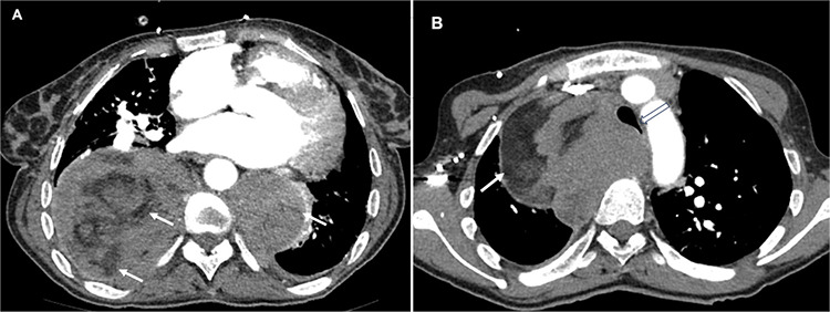 A Rare Cause of Giant Intrathoracic Mass in a Woman with Sickle Cell Disease: Extramedullary Hematopoiesis