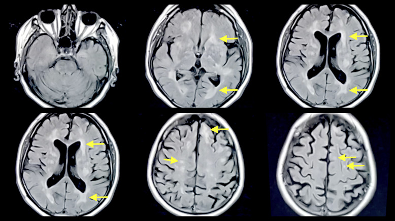Multiphasic Acute Disseminated Encephalomyelitis with a Temporal Gap of 26 Years: A Case Report with Novel Presentation.
