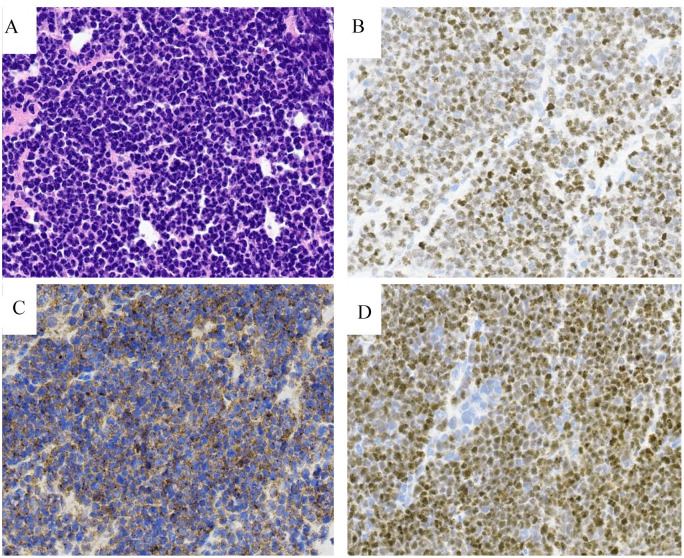 Dysuria and Vaginal Pain, Unusual Manifestations of B-acute Lymphoblastic Lymphoma.