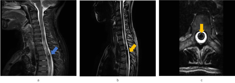 A Case of Spinal Cavernous Hemangioma with Rapidly Worsening Neurological Symptoms after COVID-19 Infection.