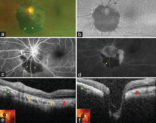 Juxtapapillary congenital hypertrophy of the retinal pigment epithelium: A report of two cases.
