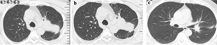 Proximal Femoral Metastasis From Epidermal Growth Factor Receptor-Mutated Lung Adenocarcinoma Mimicking Osteosarcoma on Magnetic Resonance Imaging.