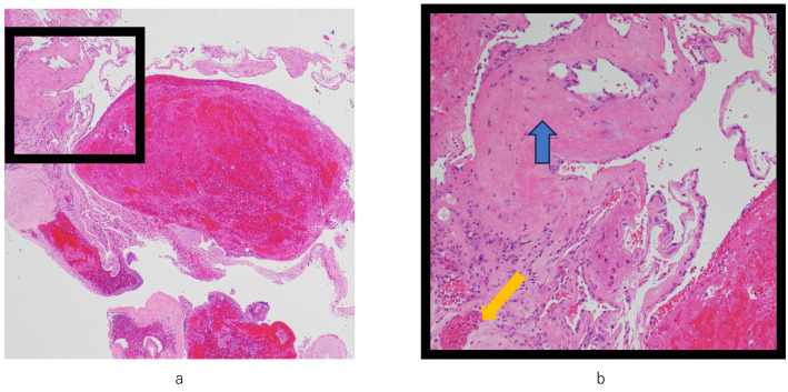 A Case of Spinal Cavernous Hemangioma with Rapidly Worsening Neurological Symptoms after COVID-19 Infection.