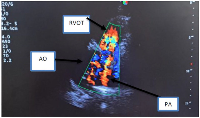 Isolated Pulmonic Valve Endocarditis: A Rare Clinical Entity.