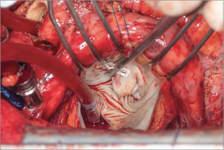 Valvular Endocarditis and Biventricular Heart Failure in the Setting of Tropheryma whipplei Disease.